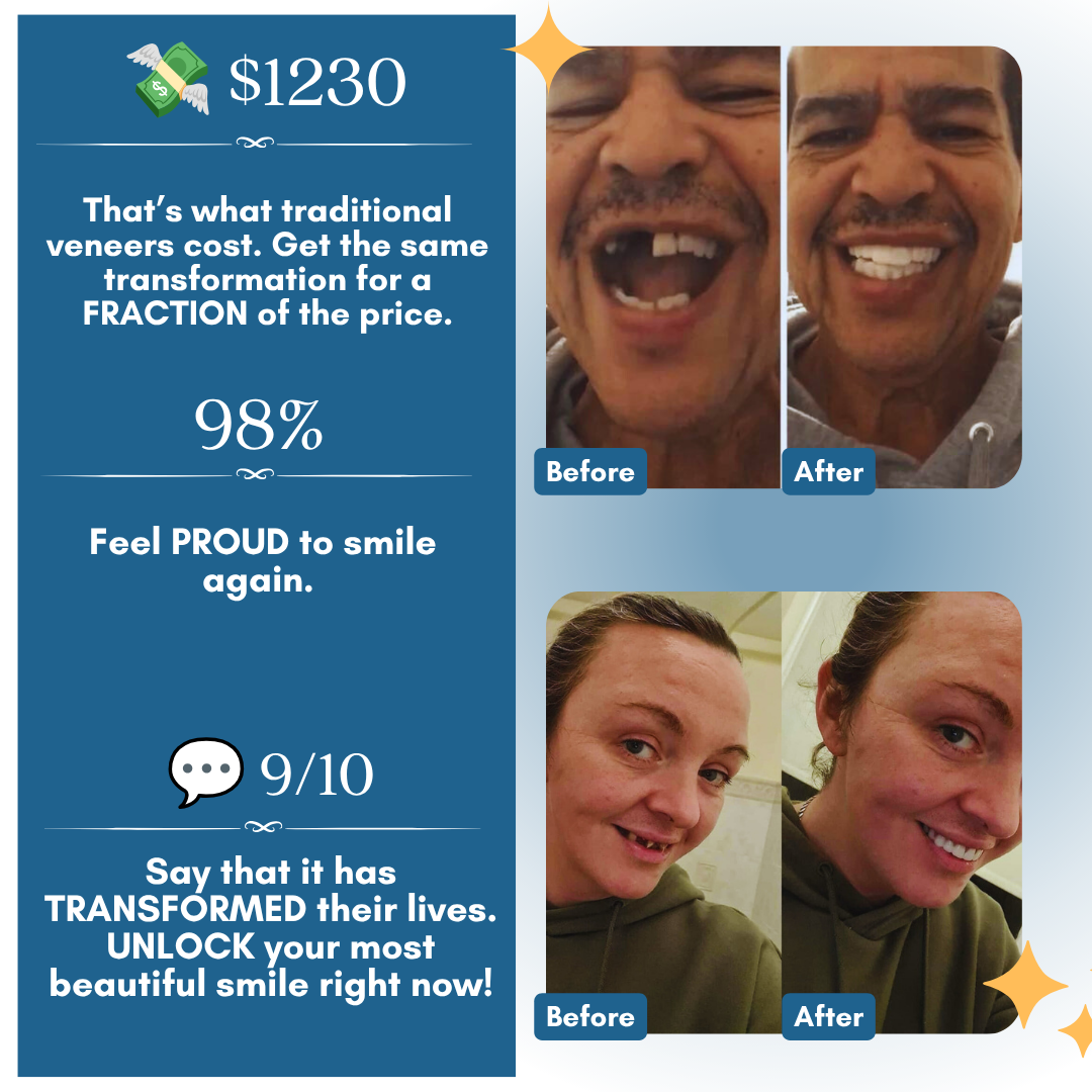 Veneers custom-made